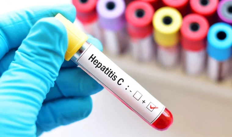 Hepatit Hastaları Beslenmede Karaciğerlerini Zorlamamalı