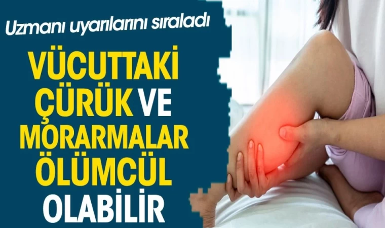 Vücuttaki Çürük ve Morarmalar Lösemi İşareti Olabilir