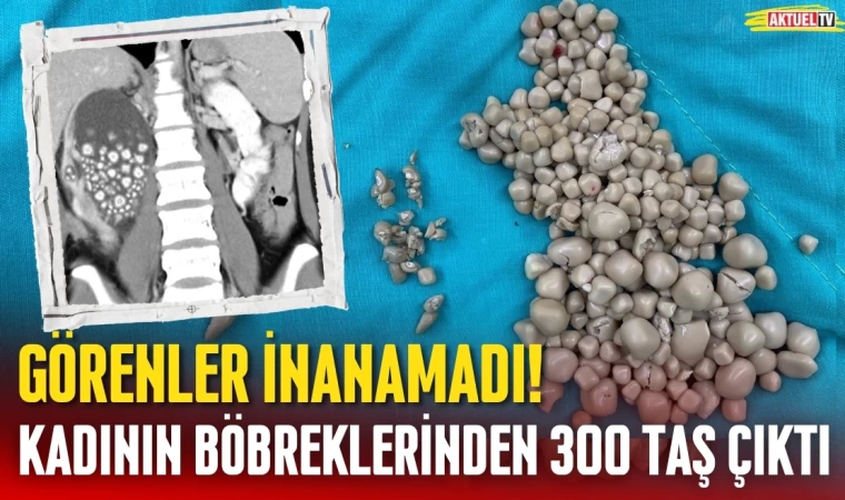 Görenler İnanamadı! Kadının Böbreklerinden 300 Taş Çıktı